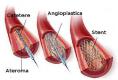 低温等离子表面处理心血管支架