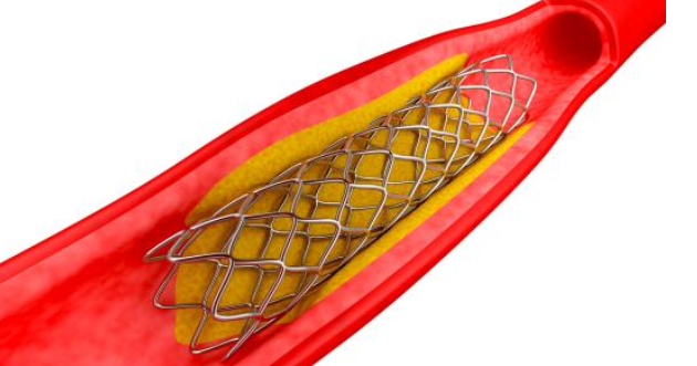 药物涂层支架图片图片